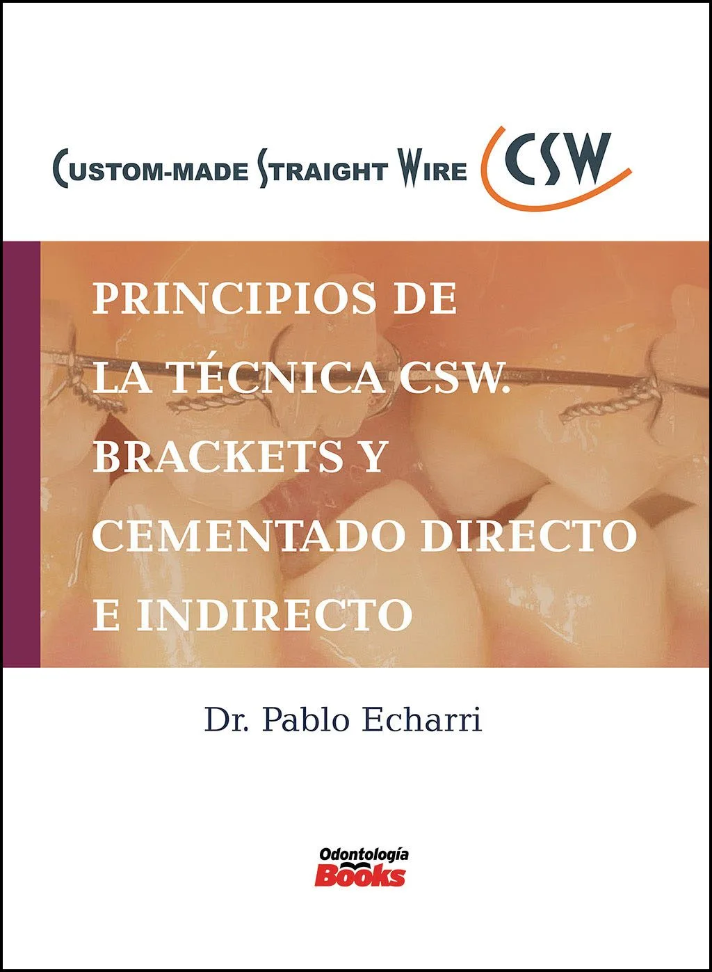 Principios de la técnica CSW. Brackets y Cementado Directo e Indirecto